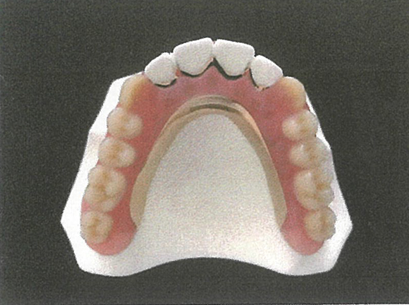 医療法人社団 なかつぼ歯科医院　部分入れ歯　ミラクルデンチャー