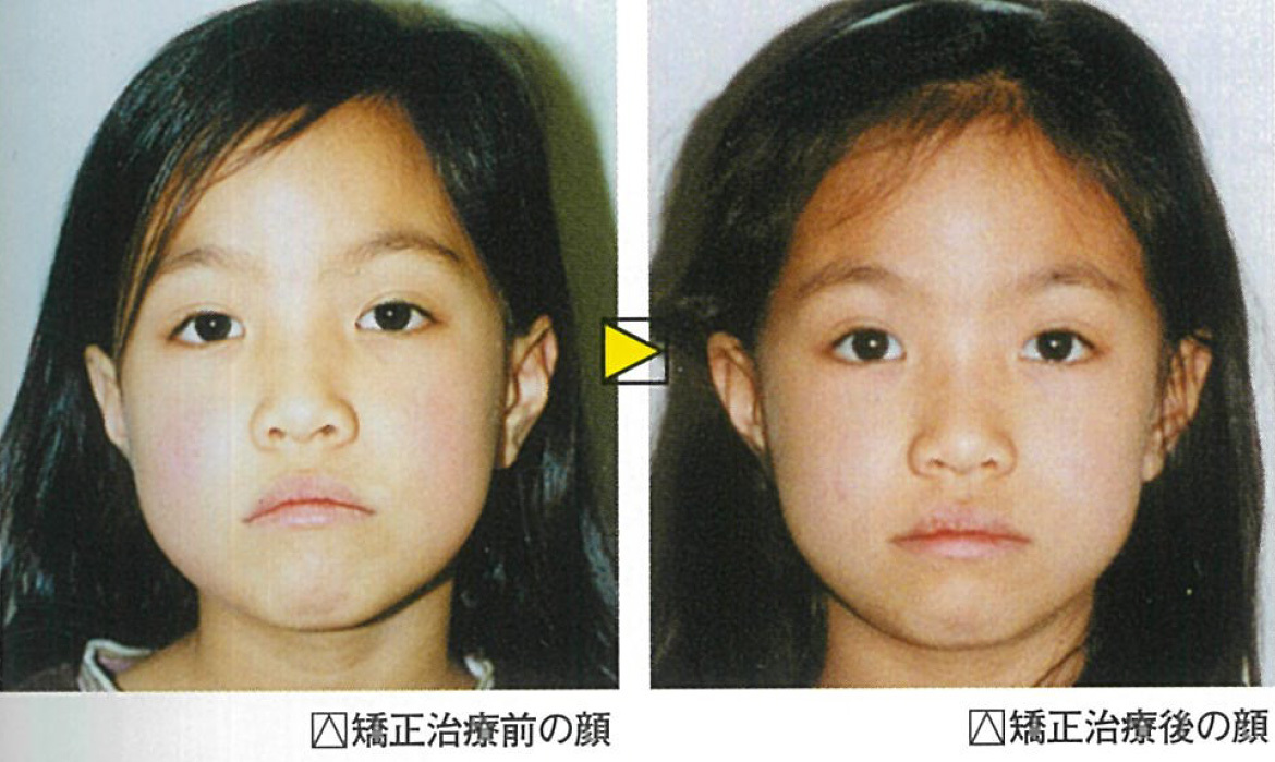 医療法人社団 なかつぼ歯科医院　矯正治療前の顔、矯正治療後の顔
