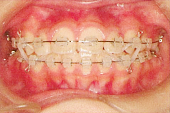 医療法人社団 なかつぼ歯科医院　矯正画像