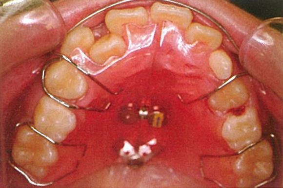 医療法人社団 なかつぼ歯科医院　矯正画像